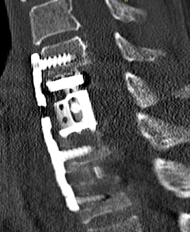 Σωματεκτομή Α6 Σπονδύλου