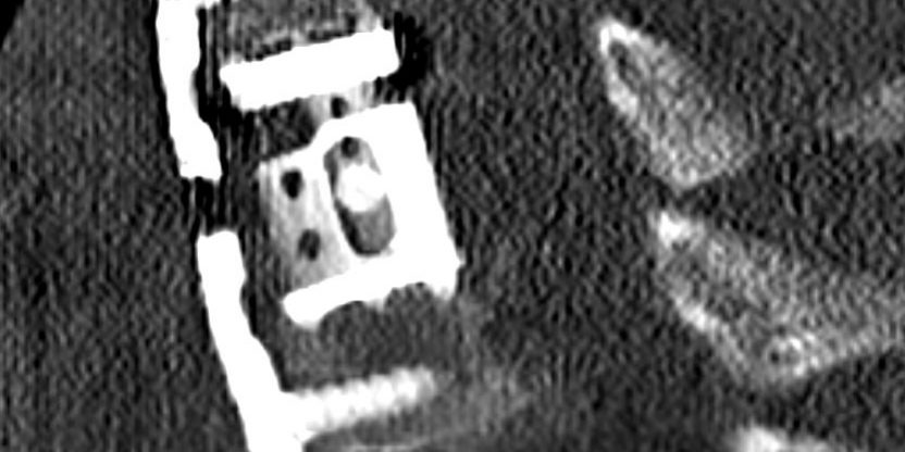 Σωματεκτομή Α6 Σπονδύλου