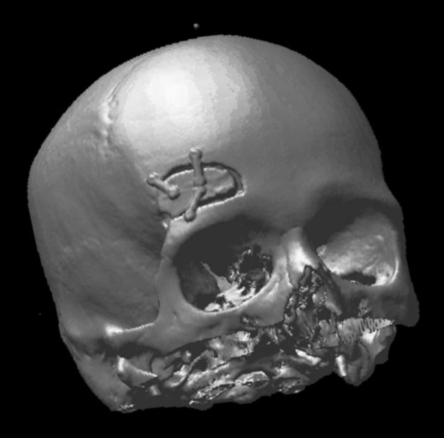 Υπερκόγχιος Κρανιοτομία Δεξιά
