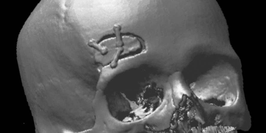 Υπερκόγχιος Κρανιοτομία Δεξιά