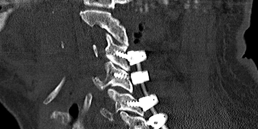 Οπίσθια Αυχενική Αποσυμπίεση και Σπονδυλοδεσία