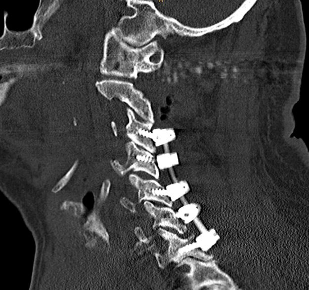 Οπίσθια Αυχενική Αποσυμπίεση και Σπονδυλοδεσία