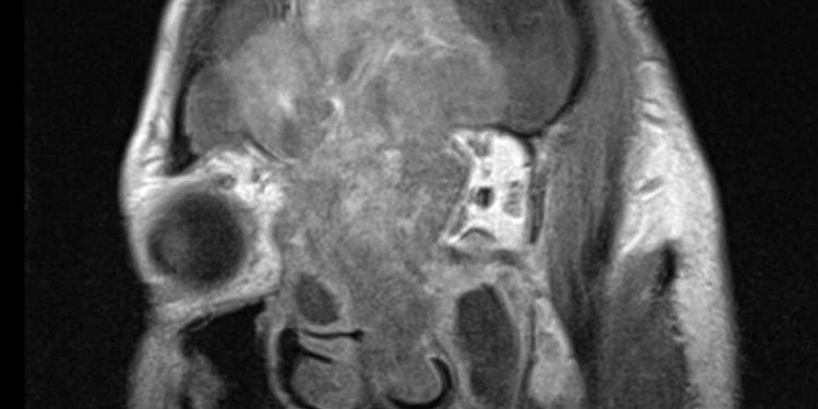 Αισθησιονευροβλάστωμα