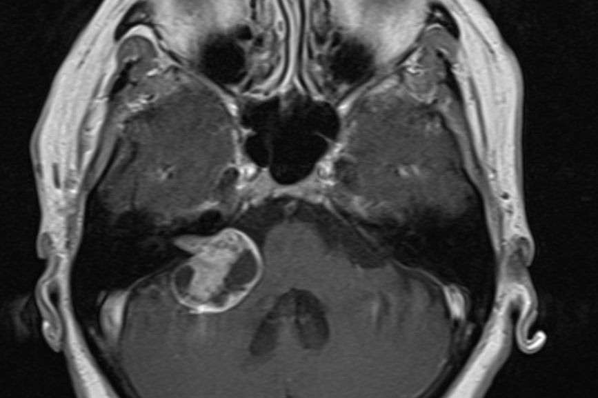 Ακουστικό Νευρίνωμα Δεξιά
