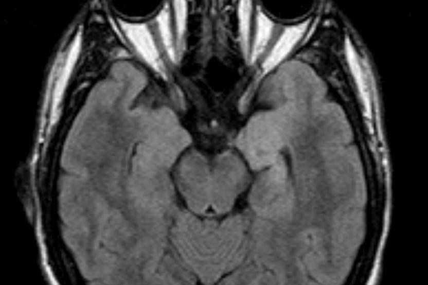 Γαγγλιογλοίωμα Ιπποκάμπου αριστερά