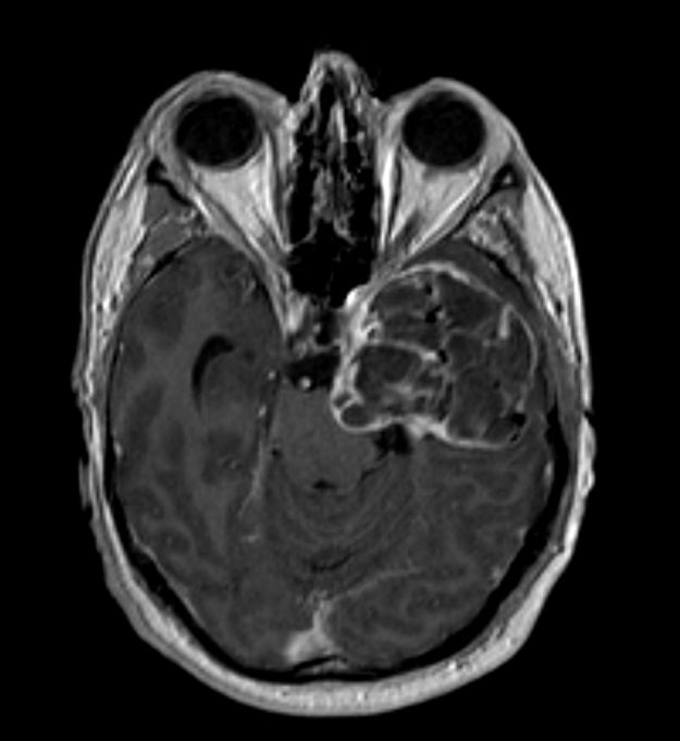 Δερμοειδής όγκος κροταφικά αριστερά
