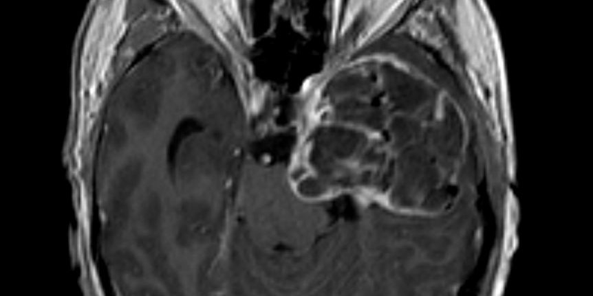 Δερμοειδής όγκος κροταφικά αριστερά