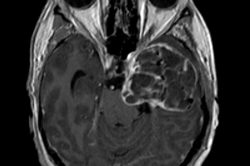 Δερμοειδής όγκος κροταφικά αριστερά