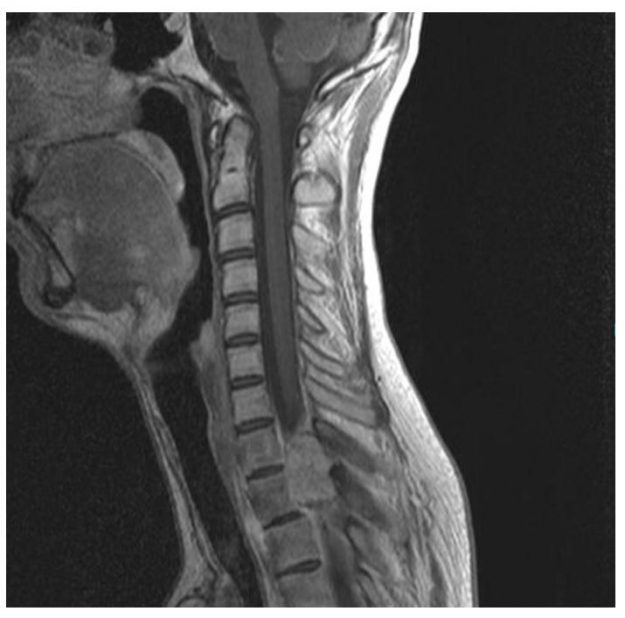 Οστεοβλάστωμα Θ1-Θ2 Σπονδύλου