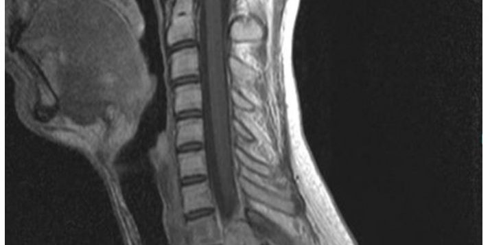 Οστεοβλάστωμα Θ1-Θ2 Σπονδύλου