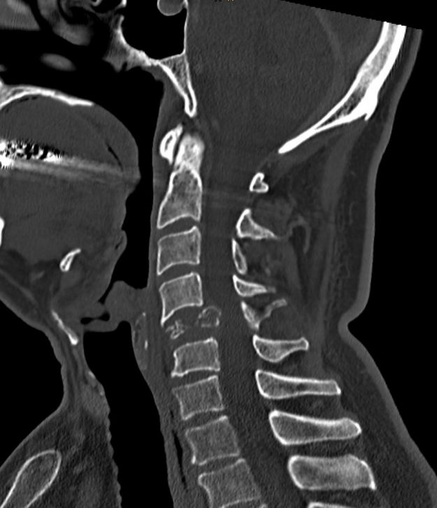 Παραγαγγλίωμα Α5 Σπονδύλου - Σωματεκτομή