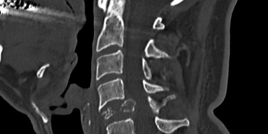 Παραγαγγλίωμα Α5 Σπονδύλου - Σωματεκτομή