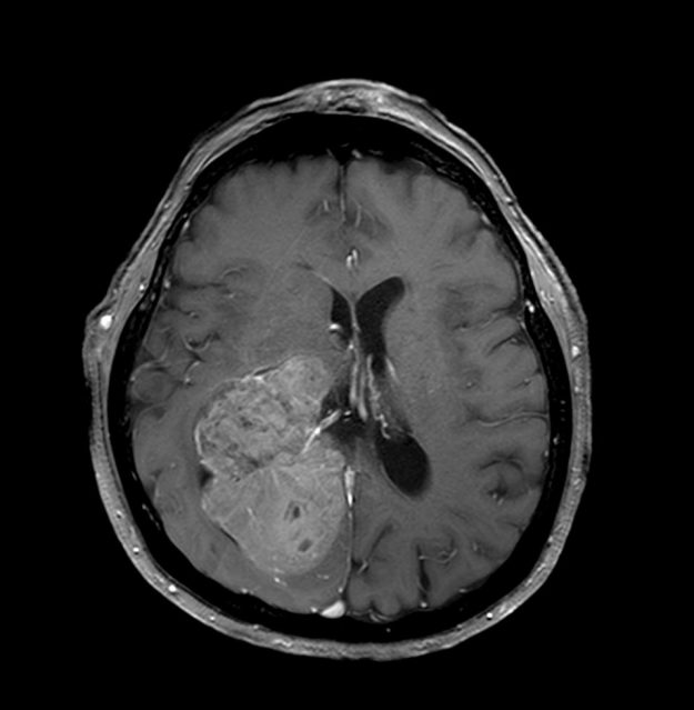 proegxiritikiΕυμεγέθες Ενδοκοιλιακό Μηνιγγίωμα Δεξιά