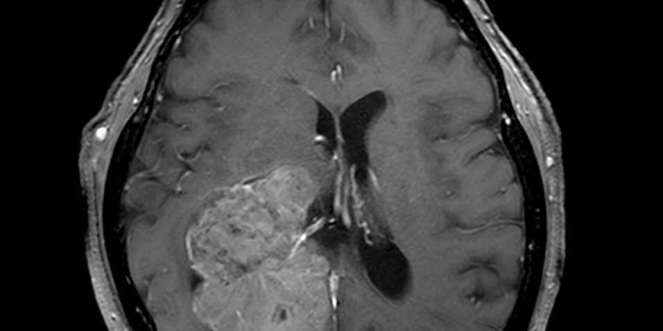 proegxiritikiΕυμεγέθες Ενδοκοιλιακό Μηνιγγίωμα Δεξιά