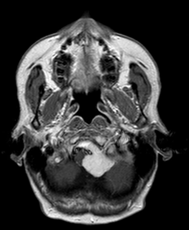 Μηνιγγίωμα Ινιακού Τρήματος