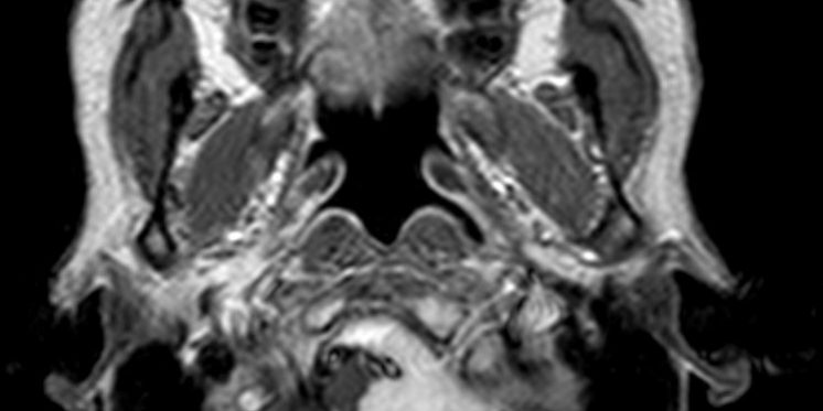 Μηνιγγίωμα Ινιακού Τρήματος