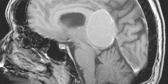 Μηνιγγίωμα περιοχής Επίφυσης