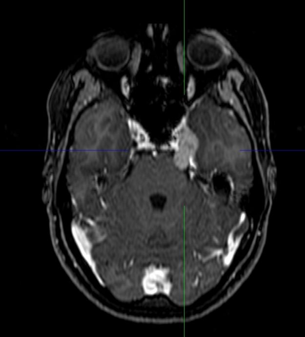 Σβάννωμα τριδύμου νεύρου αριστερά
