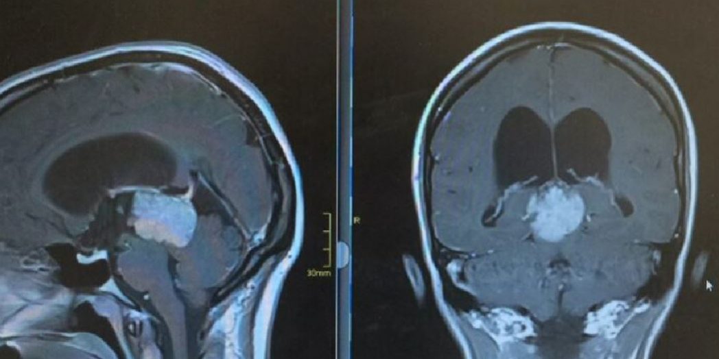 Πινεαλοκύττωμα