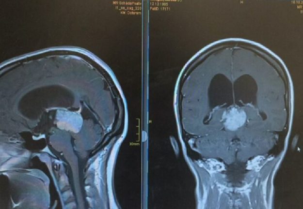 Πινεαλοκύττωμα