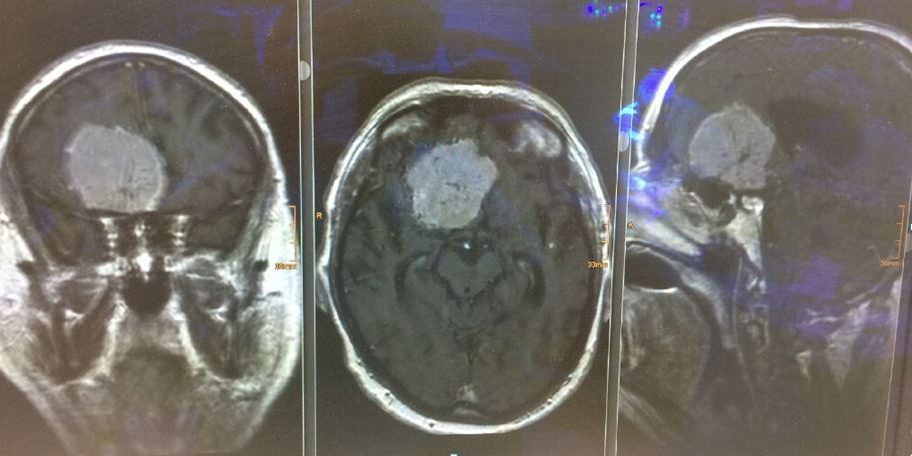 Υπερκόγχιος Κρανιοτομία Δεξιά