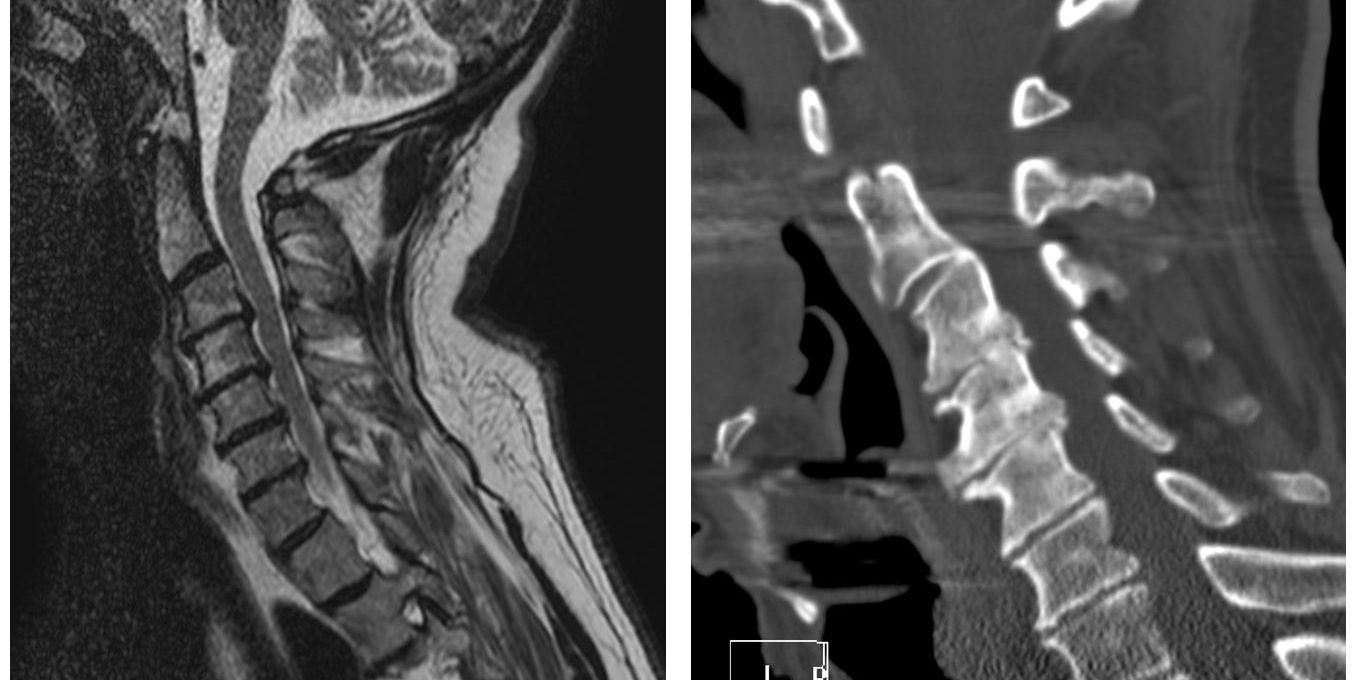 Αυχενική Δισκεκτομή σε 3 Επίπεδα