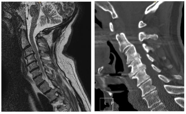 Αυχενική Δισκεκτομή σε 3 Επίπεδα