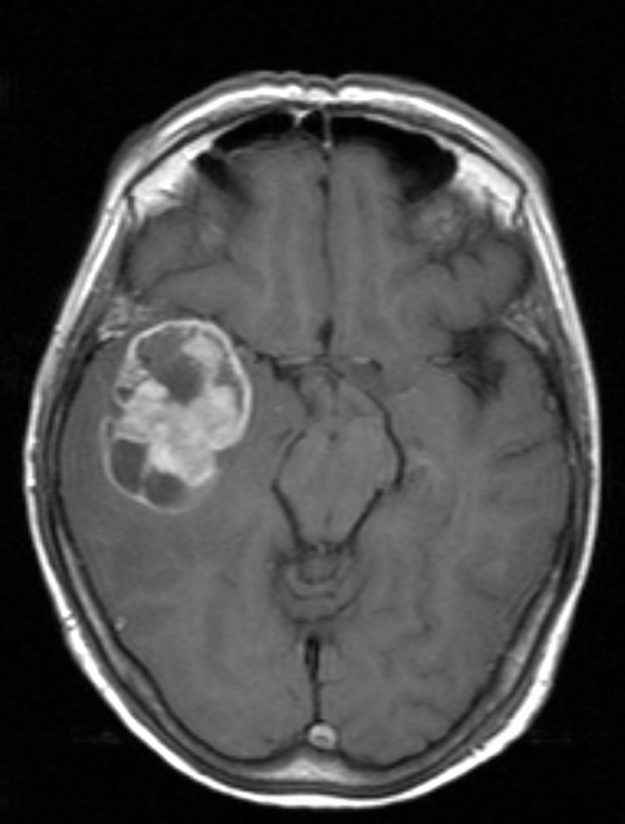 Γλοιοβλάστωμα Δεξιά Κροταφικά