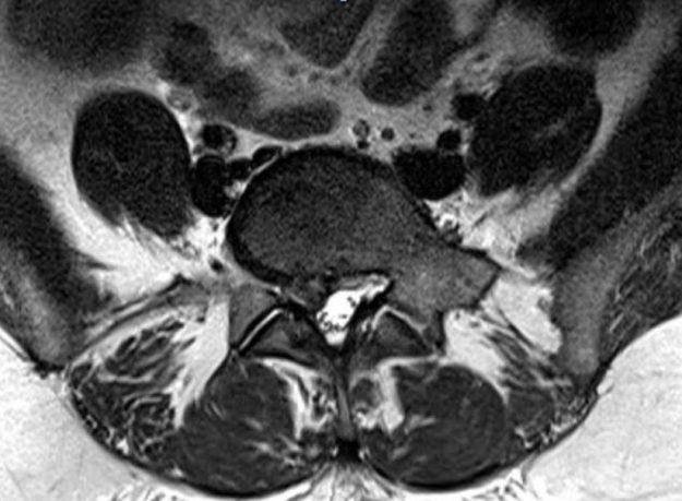 Ελάχιστα Επεμβατική Δισκεκτομή Ο4/5 δεξιά
