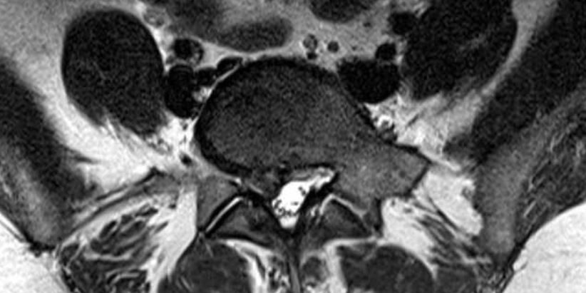 Ελάχιστα Επεμβατική Δισκεκτομή Ο4/5 δεξιά