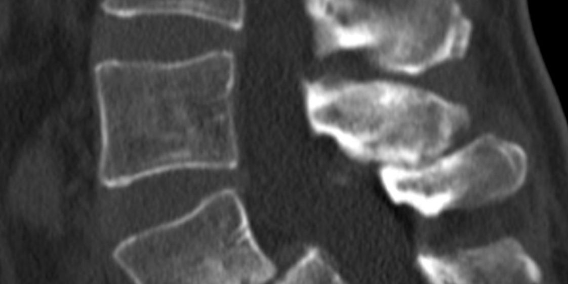 Διαδερμική (ελάχιστα επεμβατική) σπονδυλοδεσία Ο4-Ο5