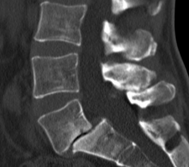 Διαδερμική (ελάχιστα επεμβατική) σπονδυλοδεσία Ο4-Ο5