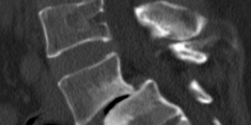 Διαδερμική (ελάχιστα επεμβατική) σπονδυλοδεσία Ο4-Ο5