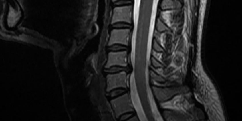 Τεχνητός δίσκος Α5/6