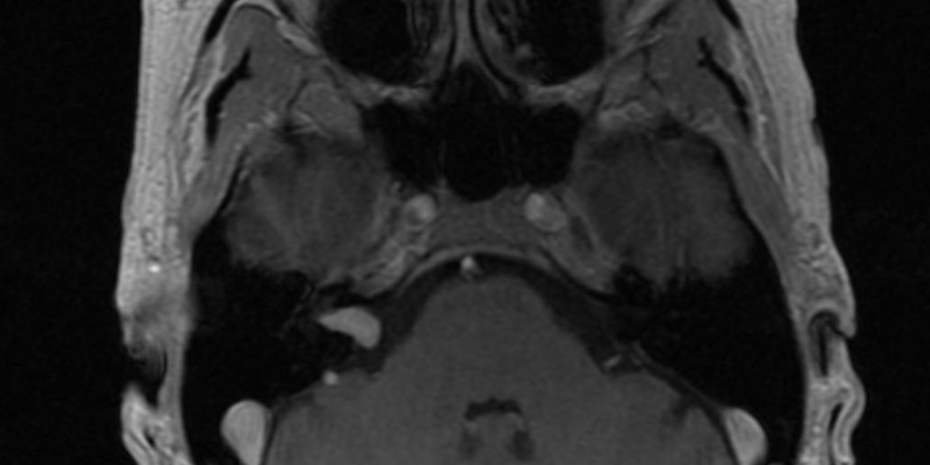 Ενδοκαναλικό Ακουστικό Νευρίνωμα Δεξιά