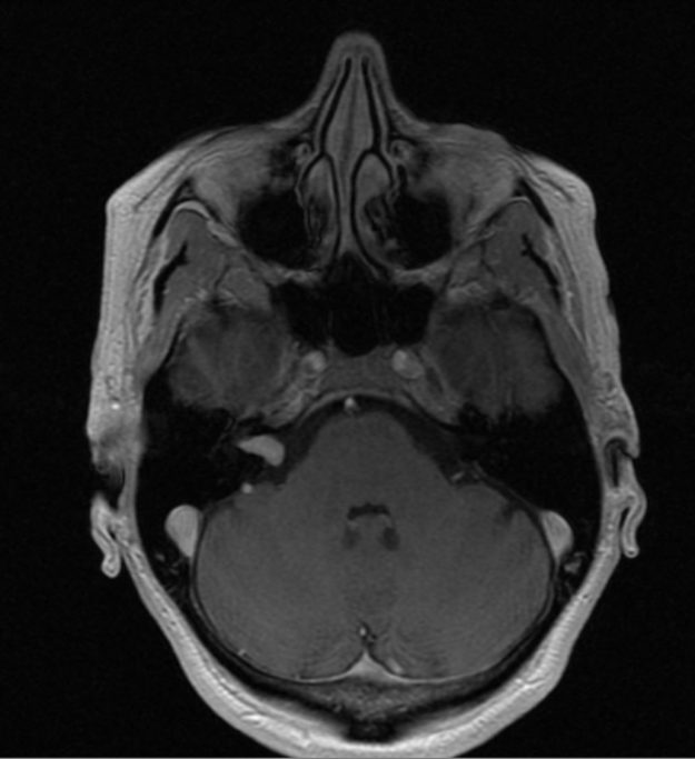 Ενδοκαναλικό Ακουστικό Νευρίνωμα Δεξιά