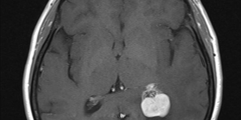 Ενδοκαναλικό Ακουστικό Νευρίνωμα Δεξιά