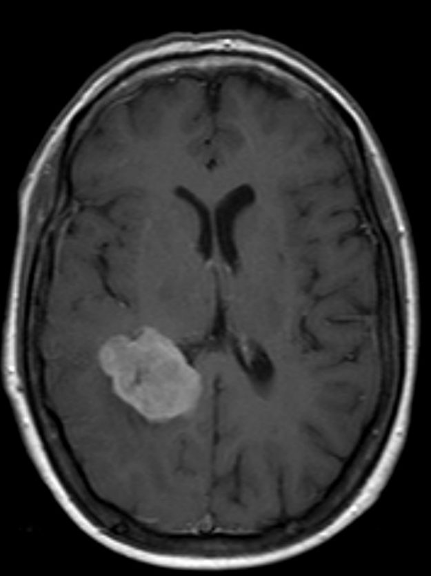 Ενδοκοιλιακό Μηνιγγίωμα Δεξιά