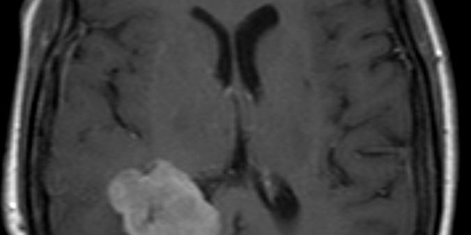 Ενδοκοιλιακό Μηνιγγίωμα Δεξιά