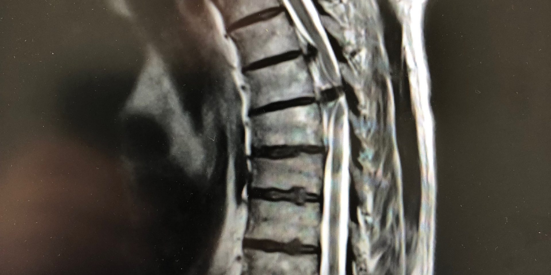 Θωρακικές Δισκοκήλες Θ6/7 και Θ7/8