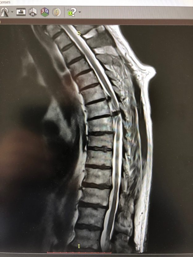 Θωρακικές Δισκοκήλες Θ6/7 και Θ7/8