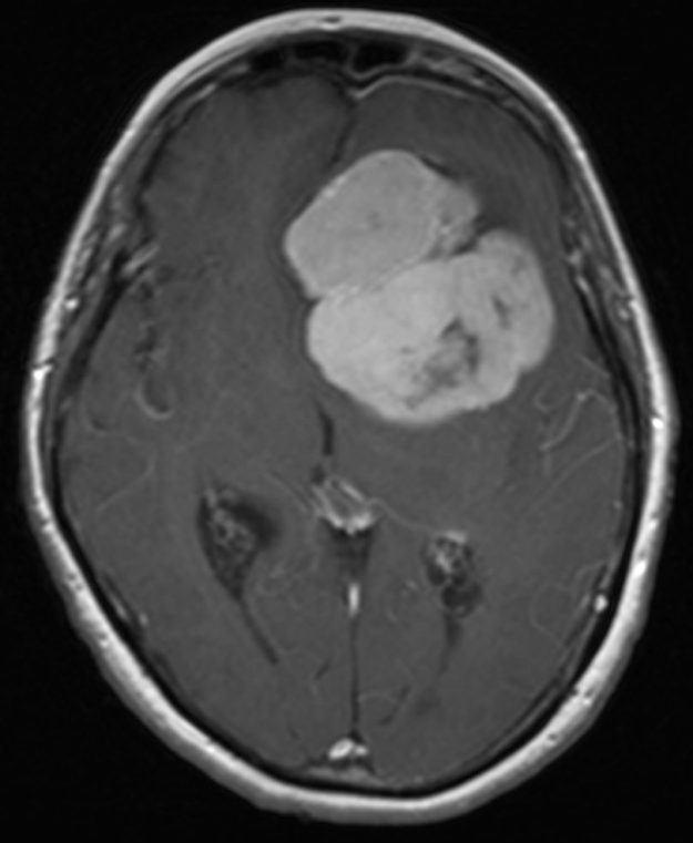 Μηνιγγίωμα της πτέρυγας του σφηνοειδούς οστού