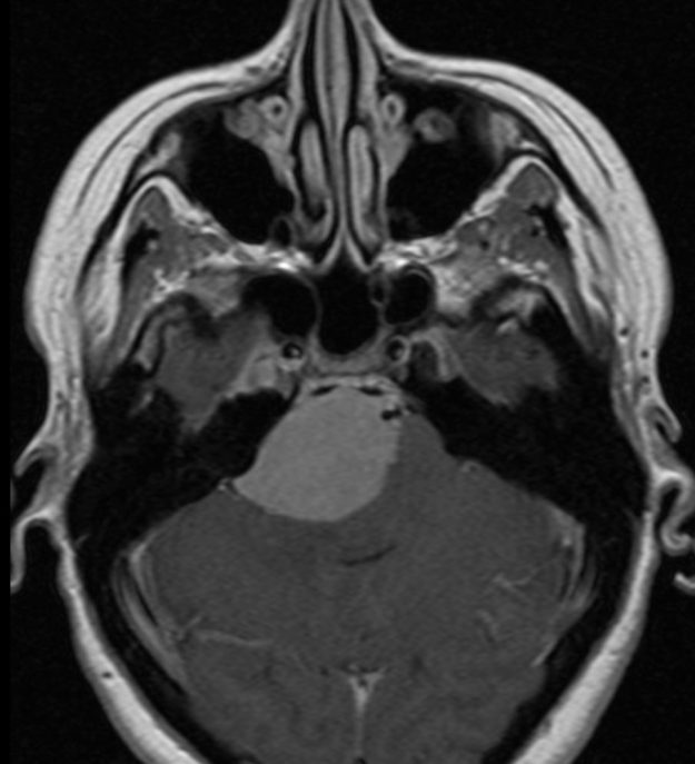 Μηνιγγίωμα Λιθοειδούς-Αποκλιματος