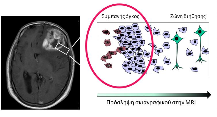 Χειρουργική γλοιωμάτων με τη χρήση 5-ALA