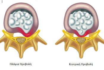 κεντρική vs πλάγια δισκοκήλη κεντρική vs πλάγια δισκοκήλη
