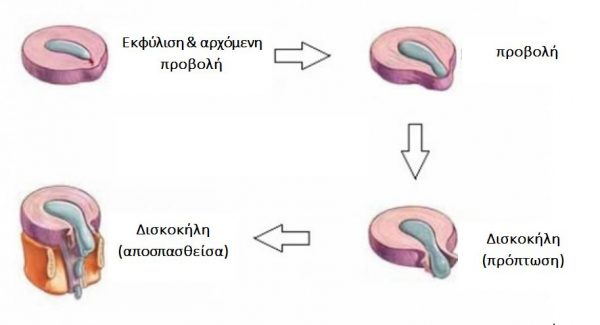 Προβολή Δίσκου vs Κήλη Δίσκου Προβολή Δίσκου vs Κήλη Δίσκου