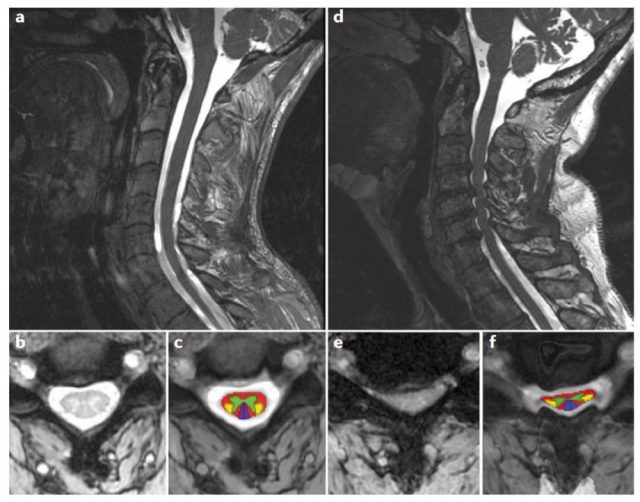 Αυχενική Μυελοπάθεια
