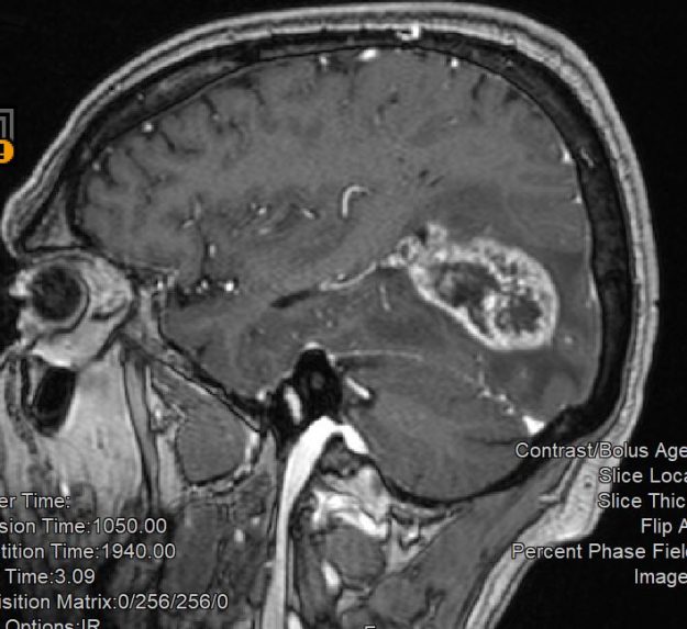 Γλοιοβλάστωμα Ινιακά αριστερά - Ολική εξαίρεση με τη χρήση 5-ALA