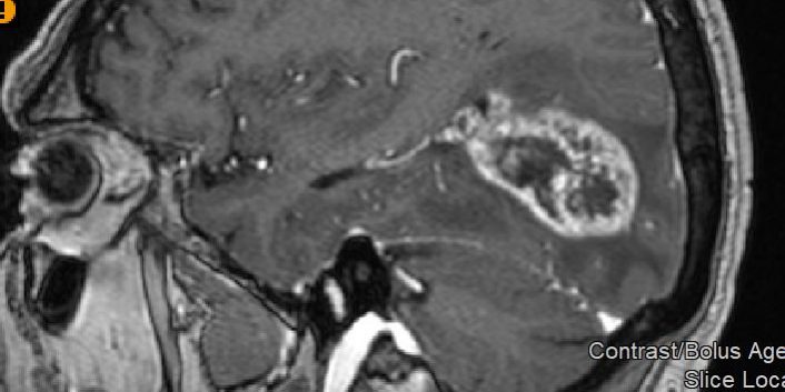 Γλοιοβλάστωμα Ινιακά αριστερά - Ολική εξαίρεση με τη χρήση 5-ALA