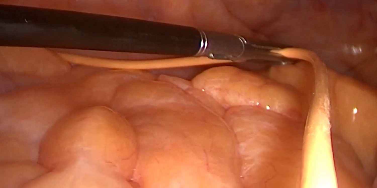 Λαπαροσκοπική τοποθέτηση περιφερικού καθετήρα βαλβίδας